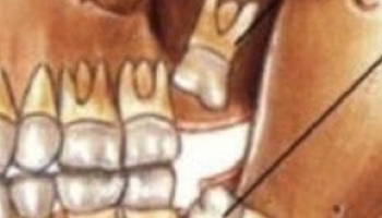 Zuby múdrosti alebo tzv. tretie moláre...